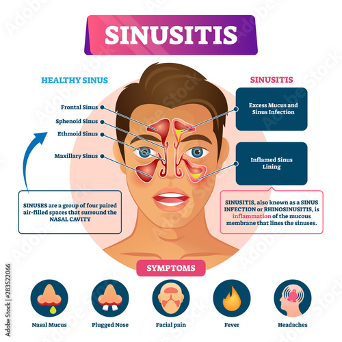 Sinusitis vector illustration. Labeled rhinosinusitis inflammation scheme. photo