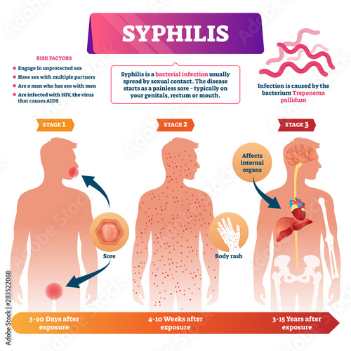 Syphilis vector illustration. Labeled sexual infection explanation scheme.
