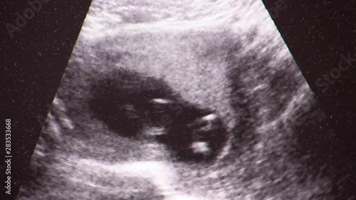  Pregnancy ultrasound examination. Pathology. Gynecologist