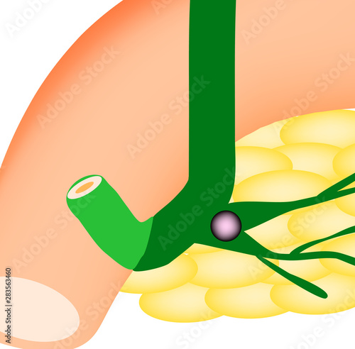 Stone pancreatic bile duct. The most dangerous rock. The gall bladder, duodenum, bile ducts. Vector illustration on isolated background