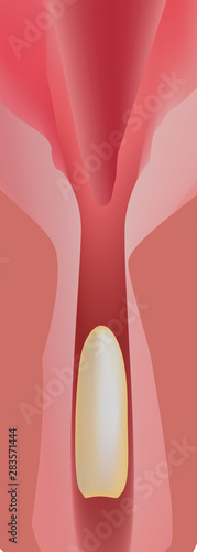 Contraceptives suppositories. Infographics. Vector illustration on isolated background