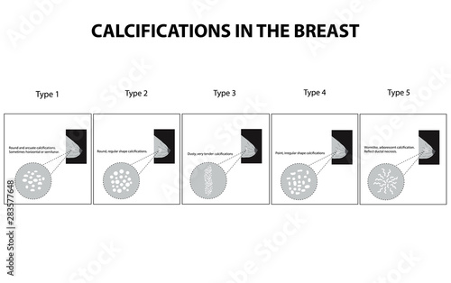 Classification of calcifications in the mammary gland. Mammography. The mammary gland. Infographics. Vector illustration on isolated background