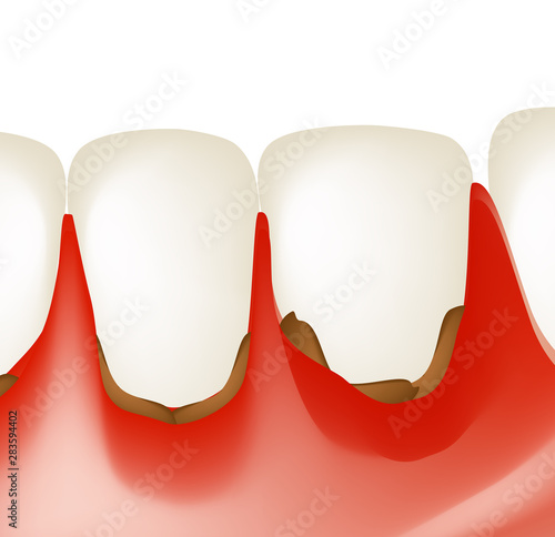 Gingivitis. Inflammation of the gums. Dental calculus. Infographics. Vector illustration on isolated background