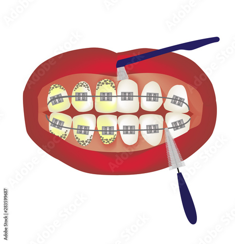 Care braces. Interdental brush teeth. Dental floss. Infographics. Vector illustration on isolated background