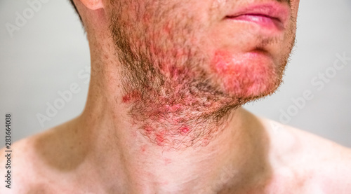 Detail of man's chin with seborrheic dermatitis in the beard area photo