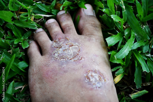 Canvastavla Inflammation caused by foot ulcers. And there are flies wound.