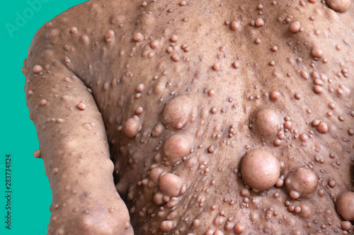Neurofibromatosis (NF) is conditions in which tumors grow, symptoms include light brown spots on the skin. photo