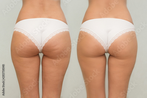 Female buttocks before and after treatment comparison
