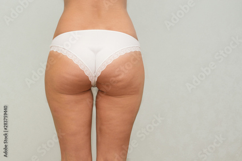 Woman buttocks and legs with cellulite close up.