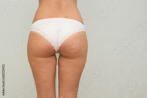 Woman buttocks and legs with cellulite close up.