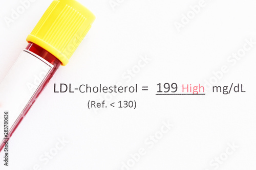 Blood sample with abnormal high LDL-cholesterol test result