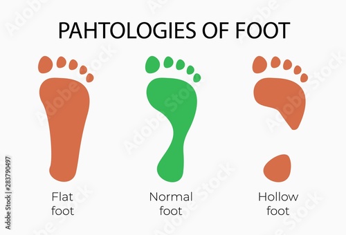 Flat normal and hollow feet .