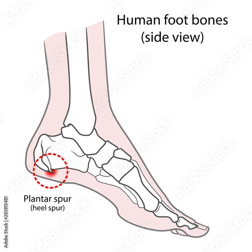 Plantar spur (calcaneal spur). Human foot bones. Vector illustration Isolated on a white background