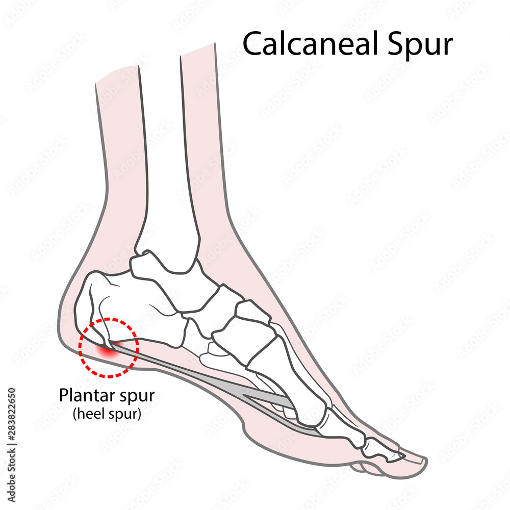 Plantar Spur Calcaneal Spur Human Foot Bones Vector Illustration Isolated On A White