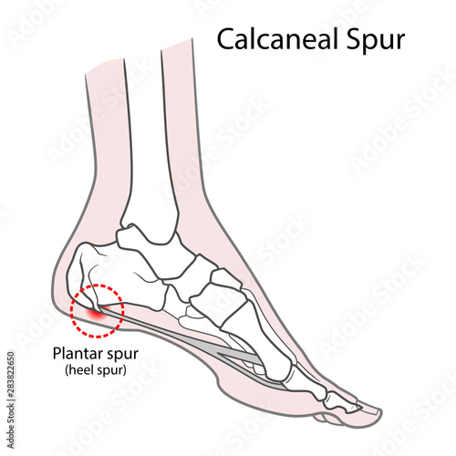 Plantar spur (calcaneal spur). Human foot bones. Vector illustration Isolated on a white background