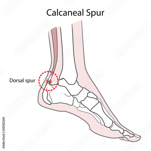 Dorsal spur (calcaneal spur). Human foot bones. Vector illustration Isolated on a white background