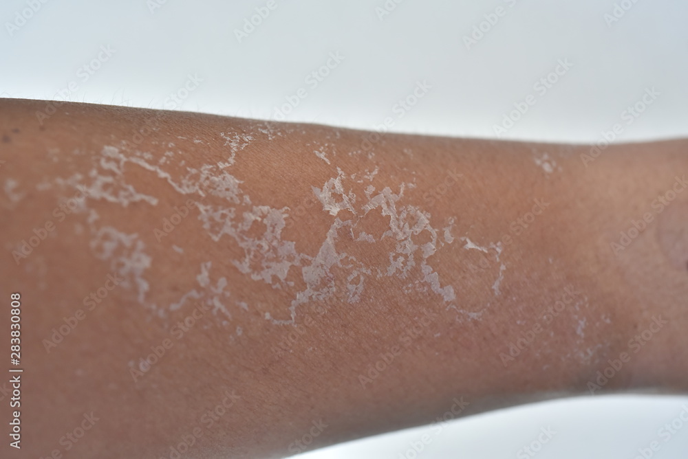 Arm dry skin peeling after sun burned Stock Photo | Adobe Stock