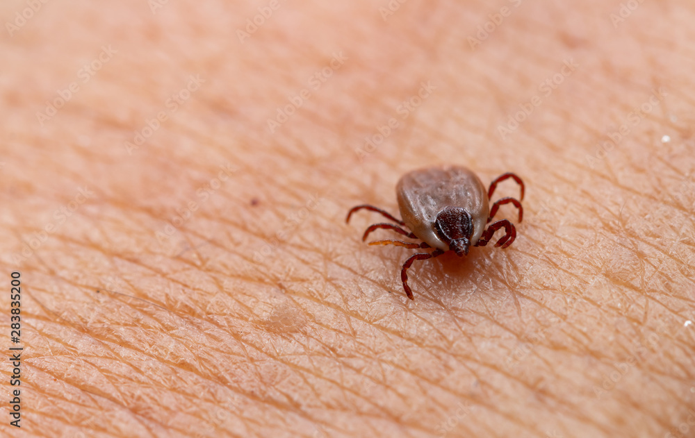 Tick filled with blood sitting on human skin. Tick filled with blood sitting on human skin.