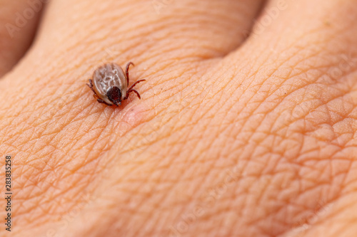 Tick filled with blood sitting on human skin. photo