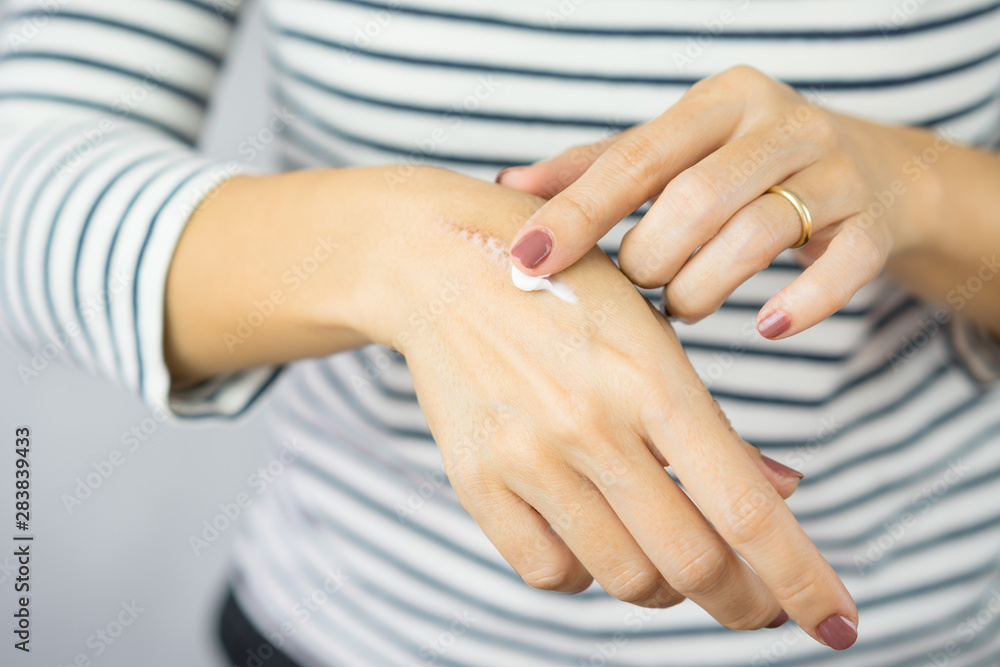 Φωτογραφία A woman applying scar removal cream to healed the cooking oil burn scar on a her hands