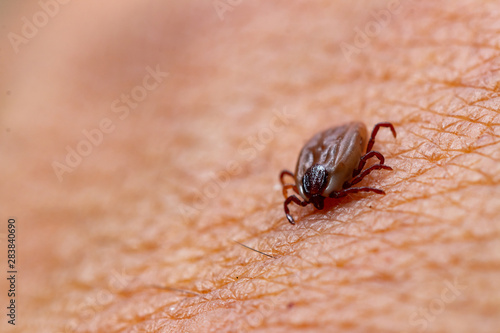 Tick filled with blood sitting on human skin.