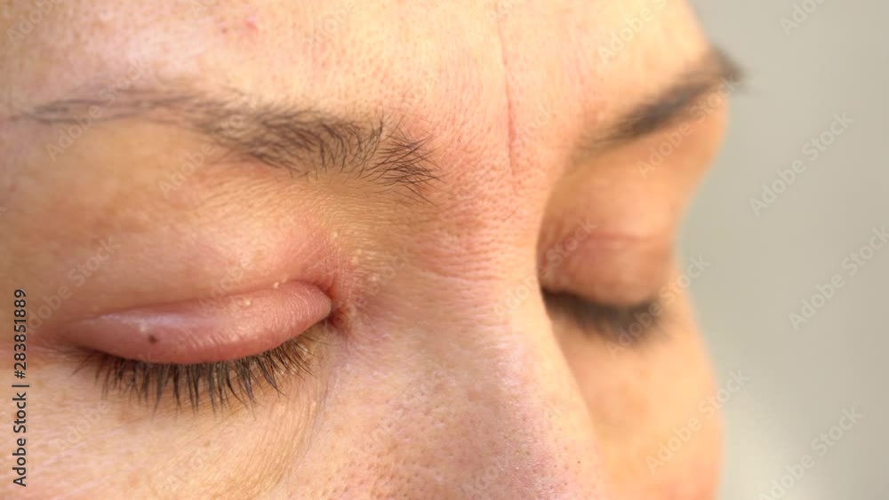 External Eyelid Stye (Hordeolum Externum). A stye or sty is a red bump, sort of like a pimple, that forms on the outside edge of the eyelid External Eyelid Stye (Hordeolum Externum). A stye or sty is a red bump, sort of like a pimple, that forms on the outside edge of the eyelid