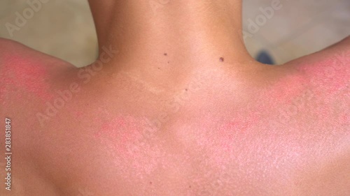 Sunburn is the result of too much exposure to the sun, or a sun-equivalent (such as a tanning bed or other UV source). Severe sunburn symptoms: redness, pain, skin peeling, skin burning and blistering photo