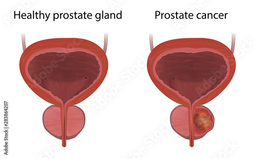 Prostate cancer, tumor and healthy gland, comparison. Realistic vector medical illustration.
