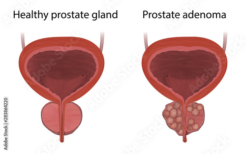 Prostate adenoma and healthy gland, comparison. Realistic vector medical illustration.