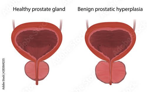 Benign prostatic hyperplasia and healthy prostate gland, comparison. Realistic vector medical illustration.