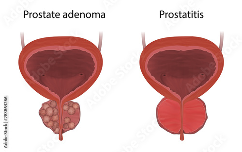 Prostate adenoma and prostatitis, comparison. Realistic vector medical illustration.