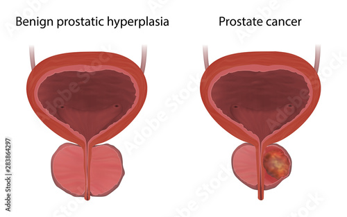 Benign prostatic hyperplasia and prostate cancer, tumor, comparison. Realistic vector medical illustration.