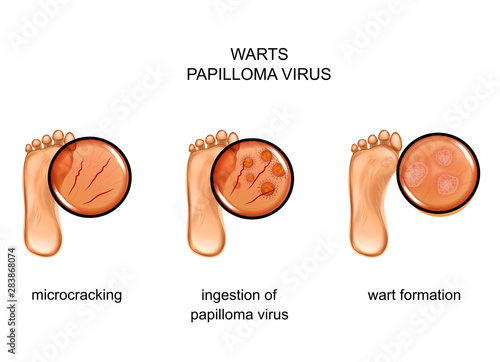 warts on the sole