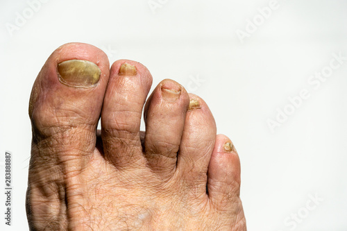 Fungus on toenail plate. Fungus on toenails. Nail plate is affected by fungus. Toenails destroyed by fungus. Finger nail fungus. Nail plates of toes are disfigured by fungus. © AlexanderDenisenko