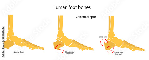 Human foot bones. Plantar and dorsal spur (calcaneal spur). Vector illustration