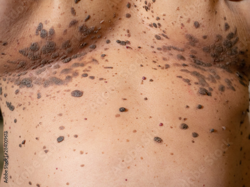 Photos close-up many large big brown nevus on human chest skin body