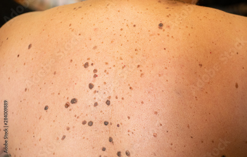 woman patient on clinical trials with lot on brown nevus on body back photo