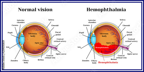 Hemophthalmia