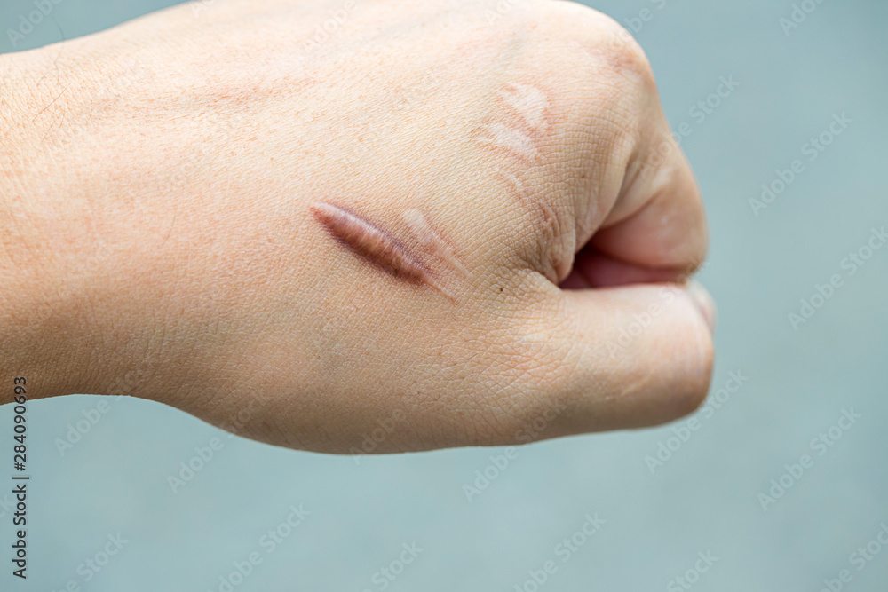 Keloid scar (Hypertrophic Scar) on man hand skin after accident. keloidal scar on wrist skin