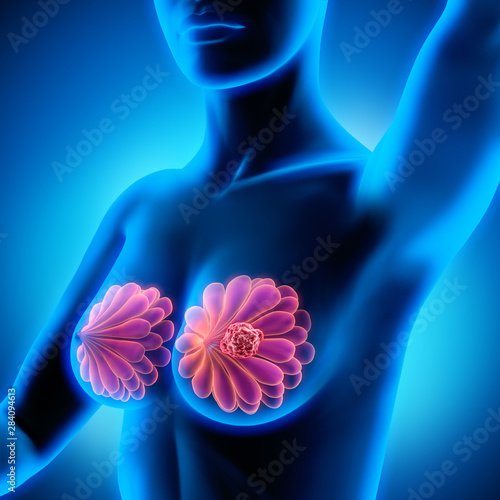 Konstfotografi Breast Cancer - Female Anatomy - pain concept