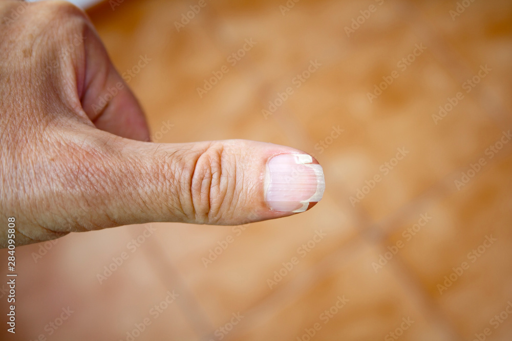 Splitting nail on the thumb of an adult male. Splitting nail on the thumb of an adult male.