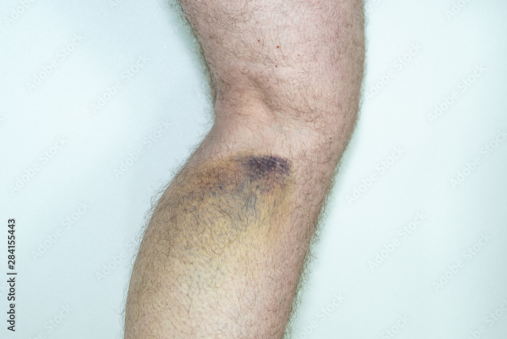 custom made wallpaper toronto digitalMuskelfaserriss an der Wade mit Hämatom beim Mann