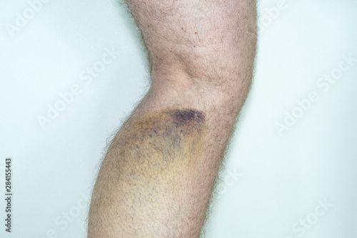 Wallpaper Mural Muskelfaserriss an der Wade mit Hämatom beim Mann Torontodigital.ca