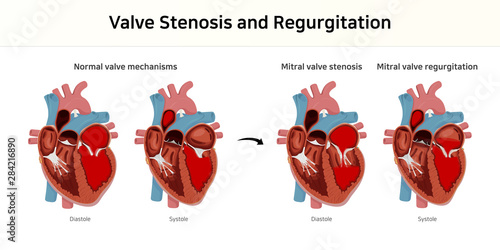 valve stenosis and regurgitation. valvular heart disease photo