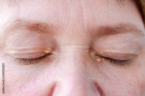 Womens eyelids with small growths due to disorders of lipid metabolism. Medical and cosmetology problem.