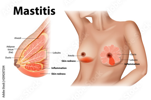 Obraz na plátně Mastitis is inflammation of the breast