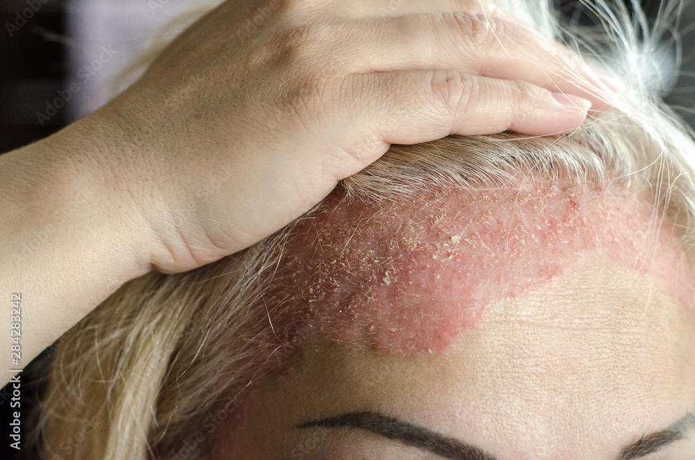 Foto de Dermatological skin disease. psoriasis, eczema, dermatitis