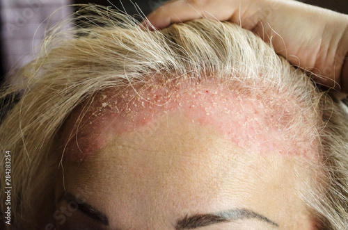 Dermatological skin disease. psoriasis, eczema, dermatitis, allergies. Skin lesions on the head. photo
