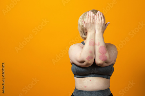 Dermatological skin disease. psoriasis, eczema, dermatitis, allergies. Skin lesions on the elbows. photo