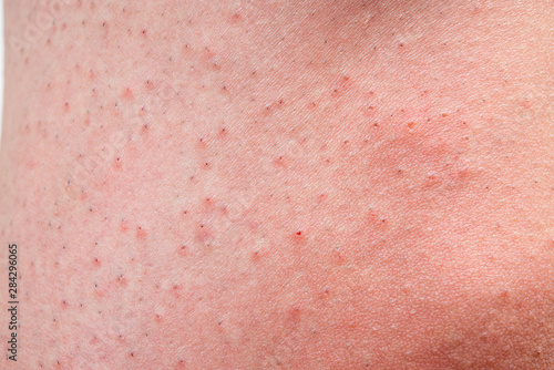 カミソリ負けして赤くなった男性の脚